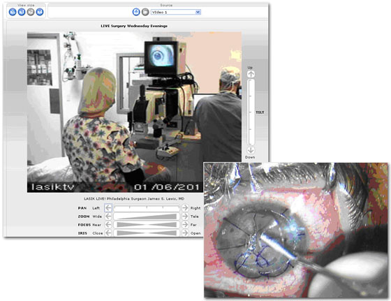 Lasik Surgery